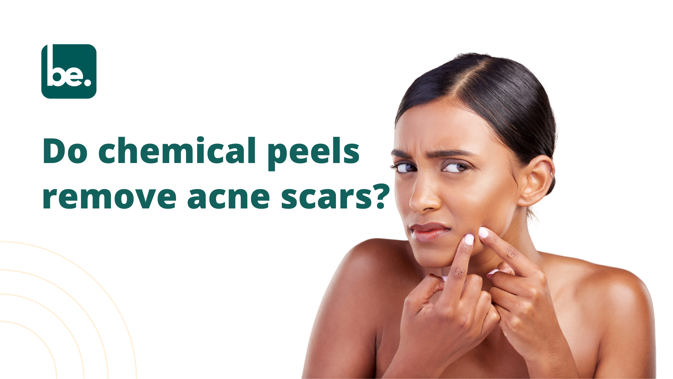 Do chemical peels remove acne scars?